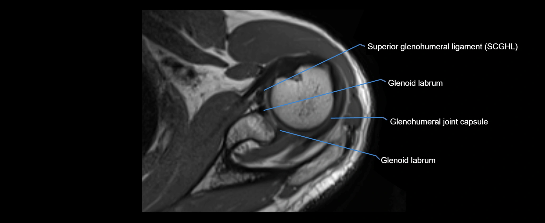 shoulder ligaments axial 3d 3t mri image-img-00005-00050.webp